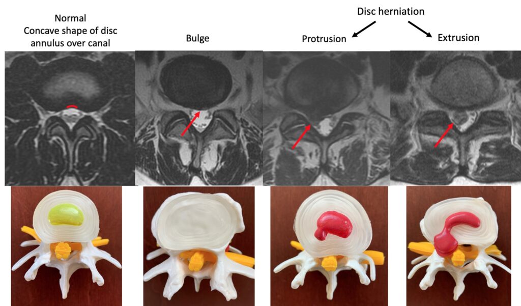 Understanding your lumbar MRI