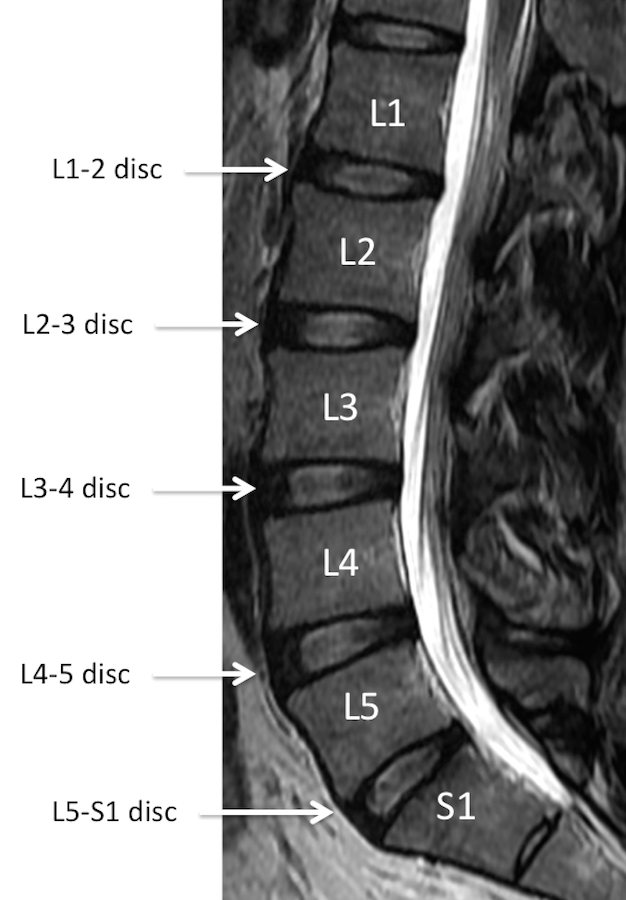 MRI Lumbar Spine Anatomy - Rocky Mountain Brain and Spine Institute