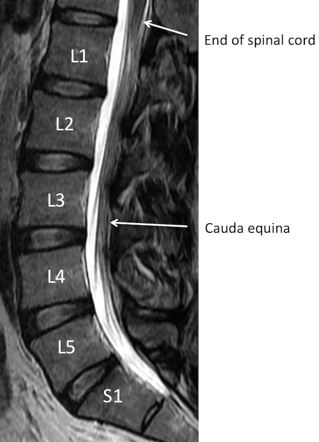 MRI Lumbar Spine Anatomy - Rocky Mountain Brain and Spine Institute