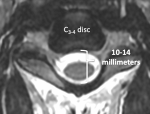 Understanding Your Cervical MRI