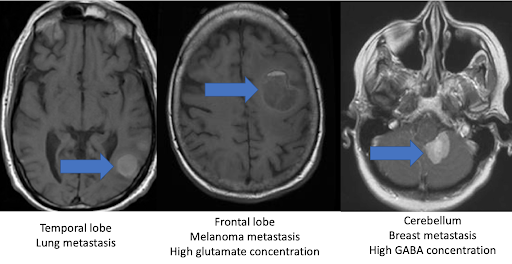 Metastatic Patterns in the Brain
