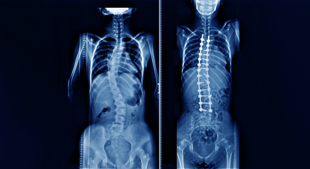 An Overview Scoliosis